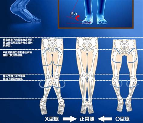 外八字腳|如何校正外八字脚